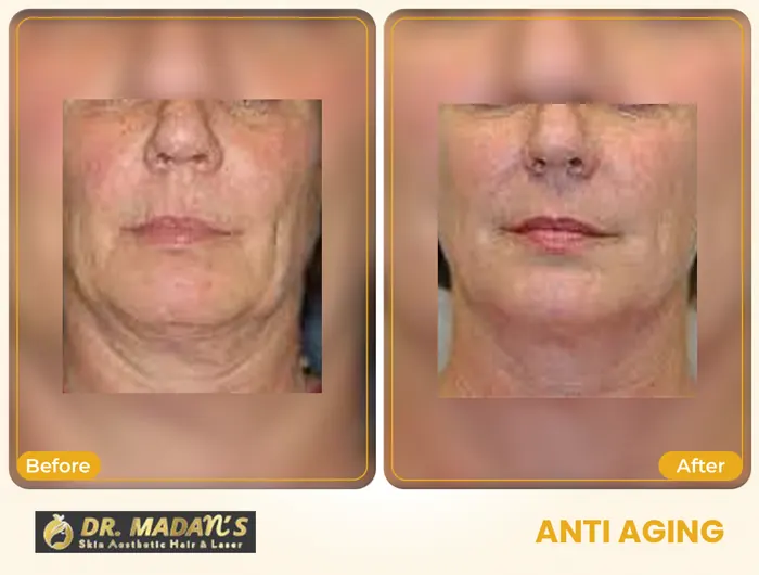 Anti aging before and after result 4 at Dr Madan Aesthetics